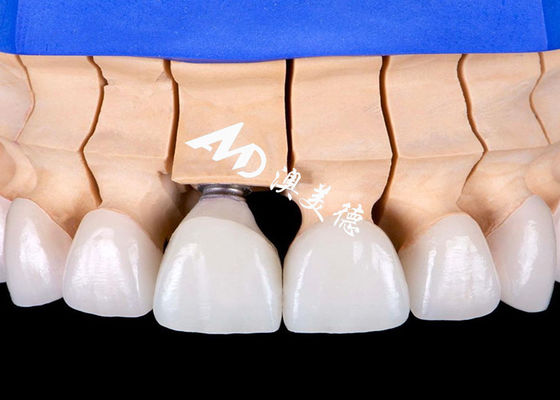 İyi bir fiyat. Doğal görünümlü estetikle biyolojik uyumlu titanyum alaşım tabanlı diş implantı taç köprüsü çevrimiçi