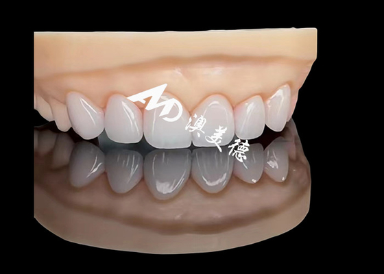 İyi bir fiyat. Porselen EMAX Veneer Yüksek Hassasiyetli Estetik Restorasyonlar Üstün Dayanıklılık çevrimiçi