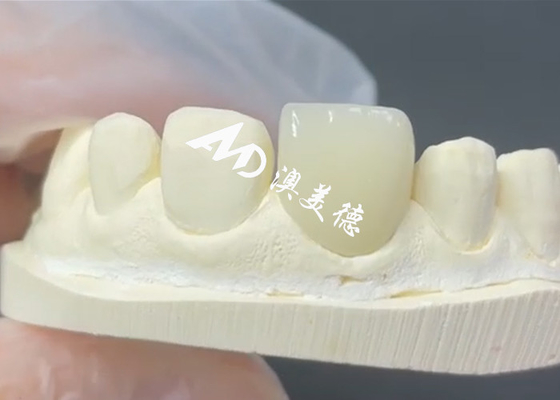 İyi bir fiyat. Dayanıklı ve Estetik EMAX Finer Porselen Restorasyonları için Mükemmel Çözüm çevrimiçi
