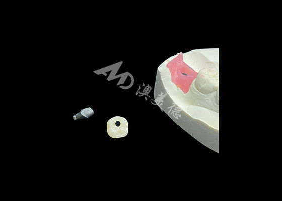 İyi bir fiyat. Diş İmplantı Taçları Restoratif Diş Hekimliği Prosedüründe Devrim Yarattı çevrimiçi